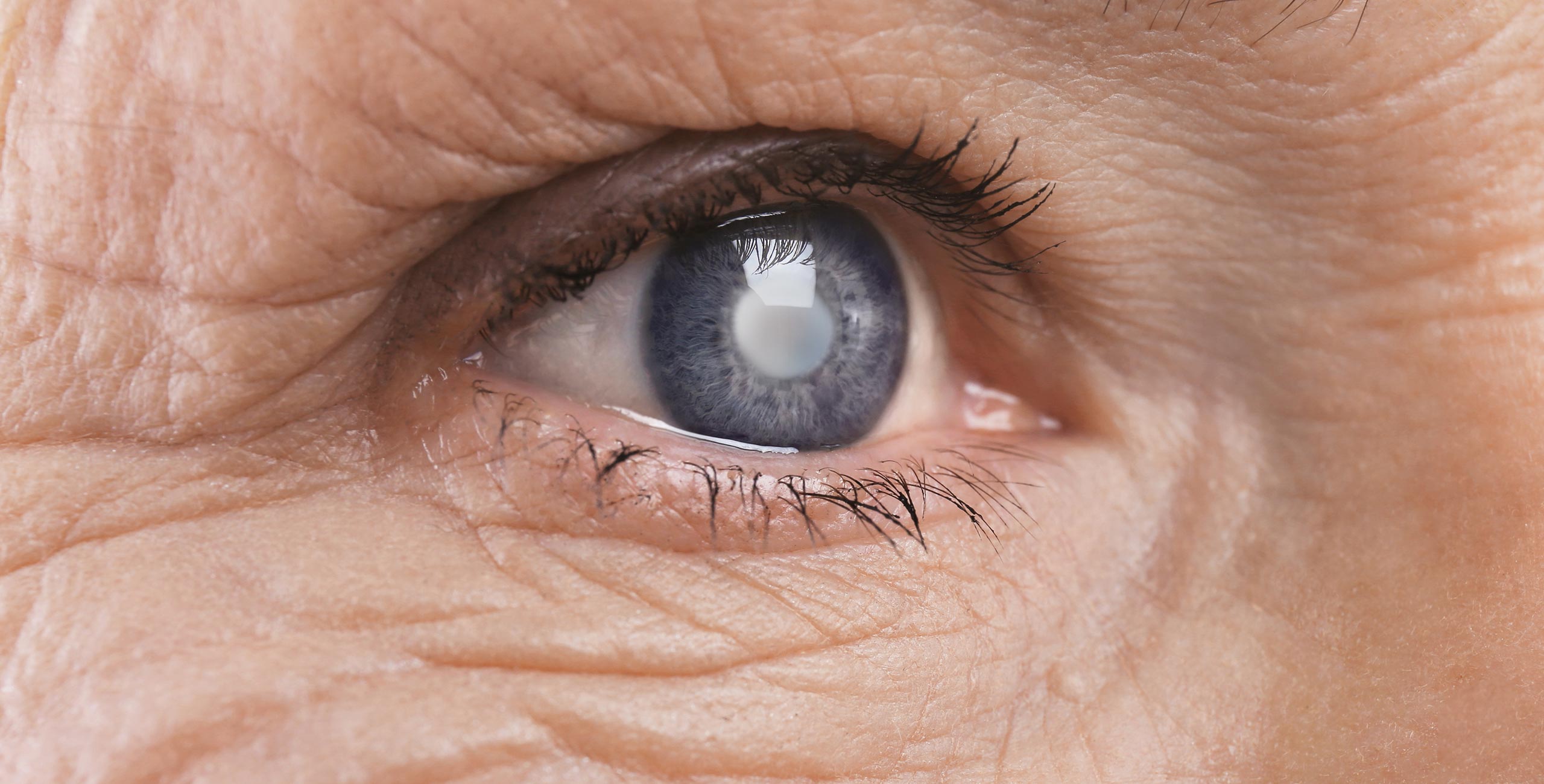 La maladie de la cataracte - Centre ophtalmologique COSS Paris 5
