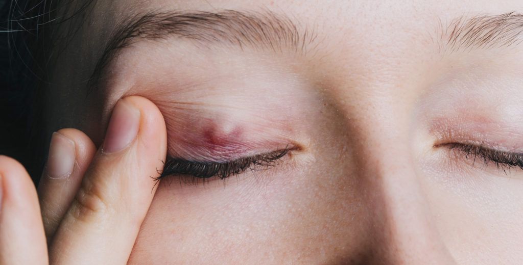 Chalazion diagnostic et traitement à Paris au Centre Ophtalmologique COSS