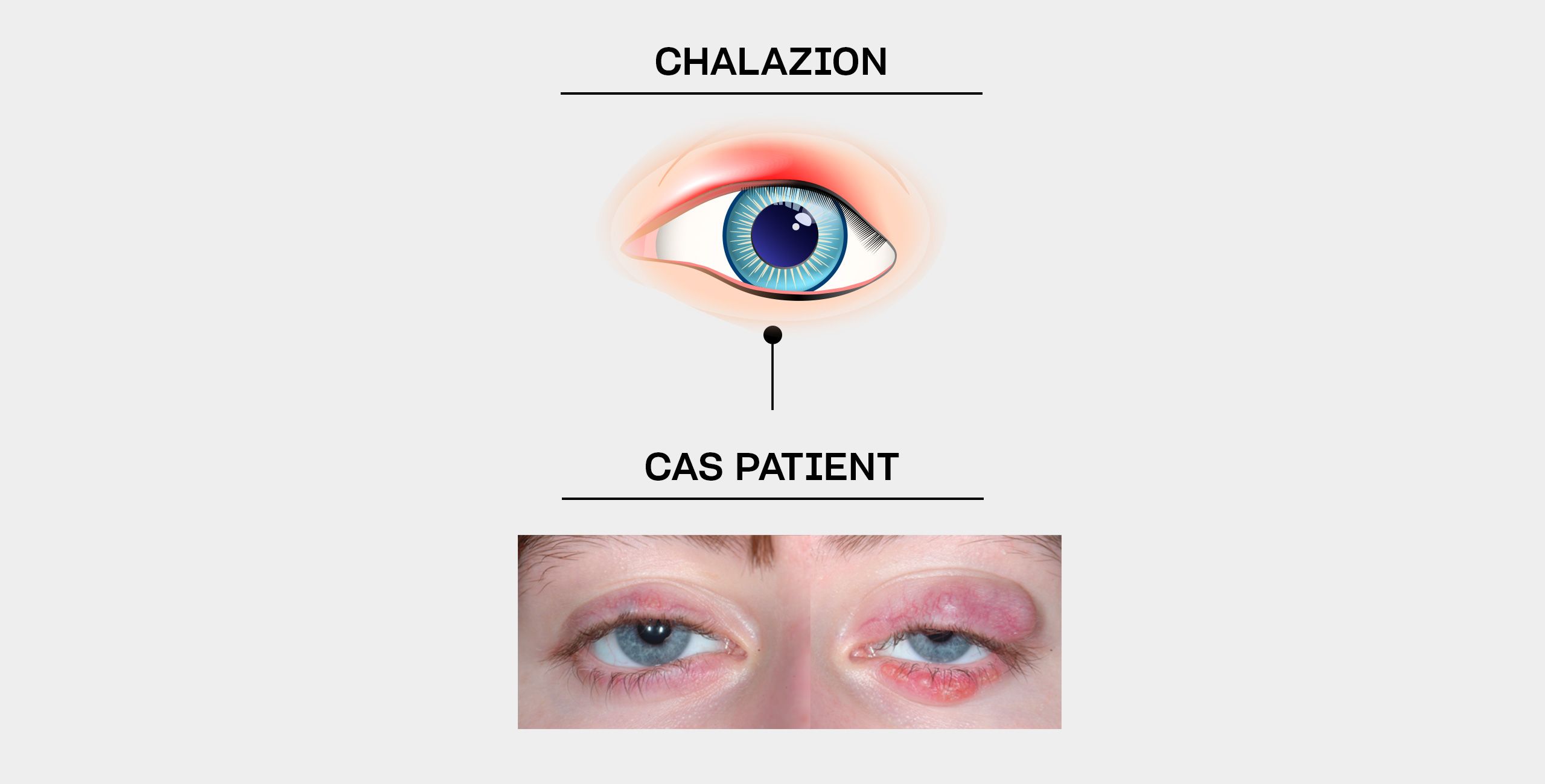 La chirurgie du chalazion à Paris 5 au Centre ophtalmologique COSS