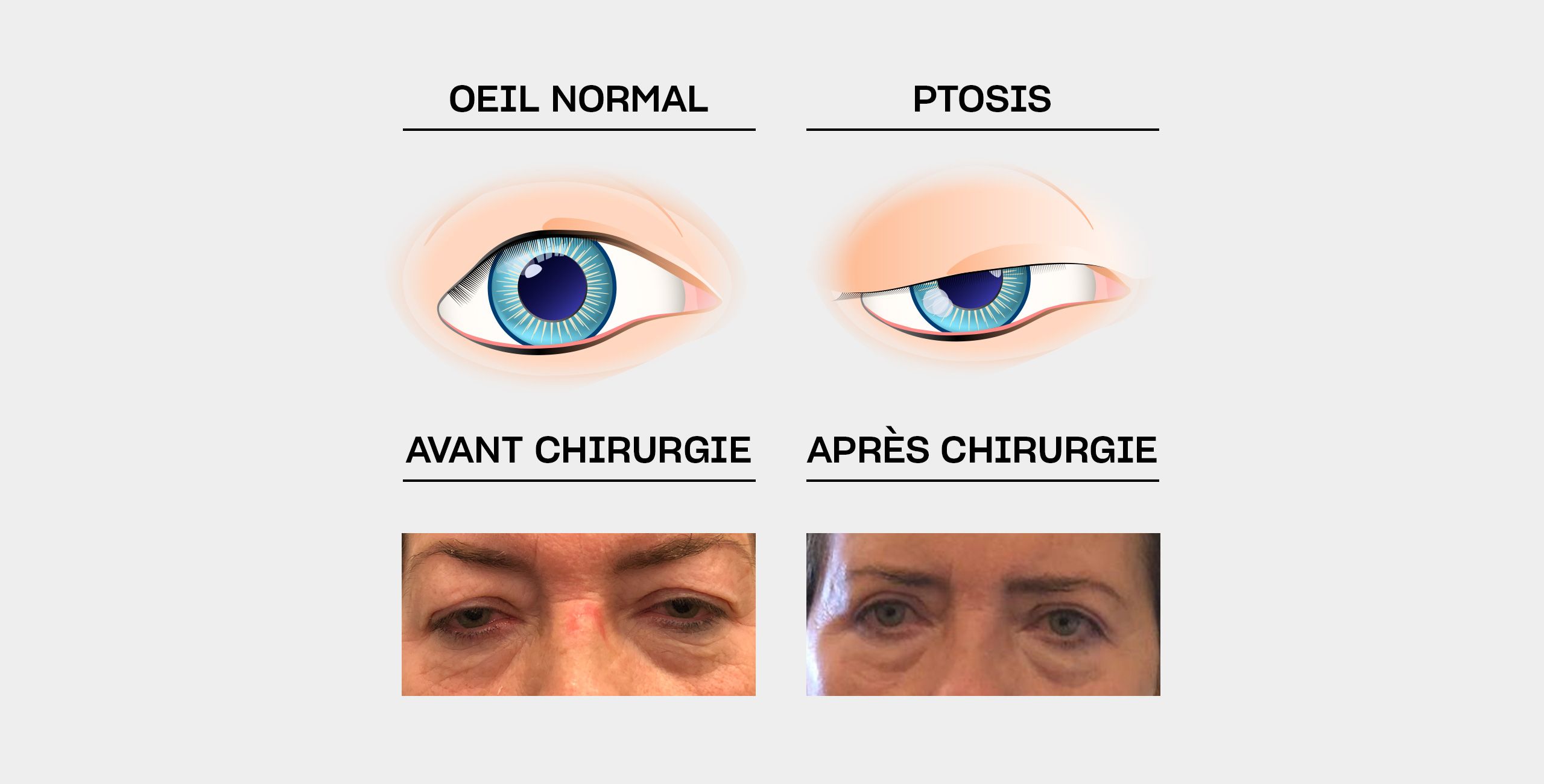 Le traitement du ptosis à Paris 5 au Centre ophtalmologique COSS