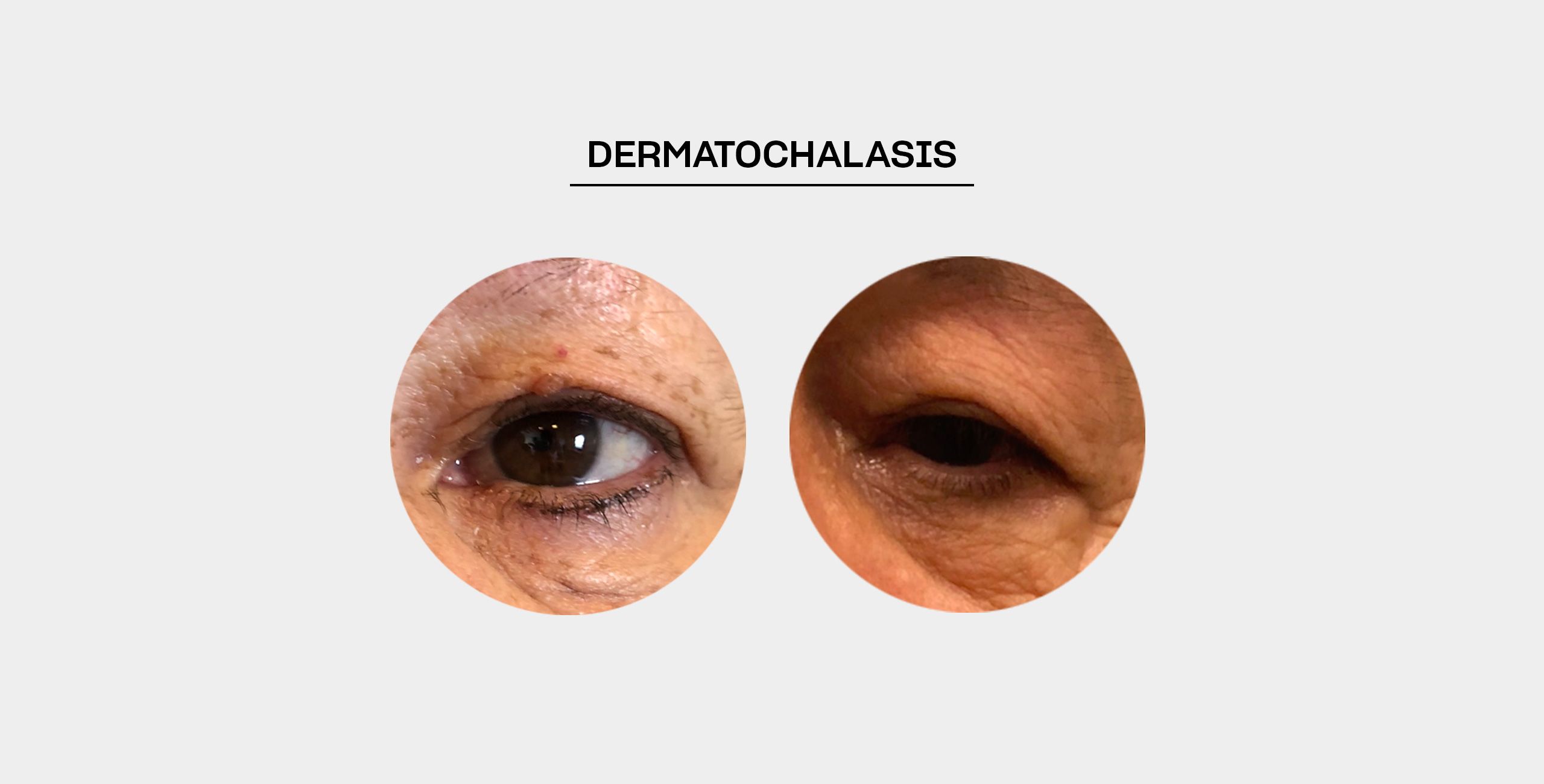 Traitement du dermatochalasis à Paris 5 au Centre ophtalmologique COSS