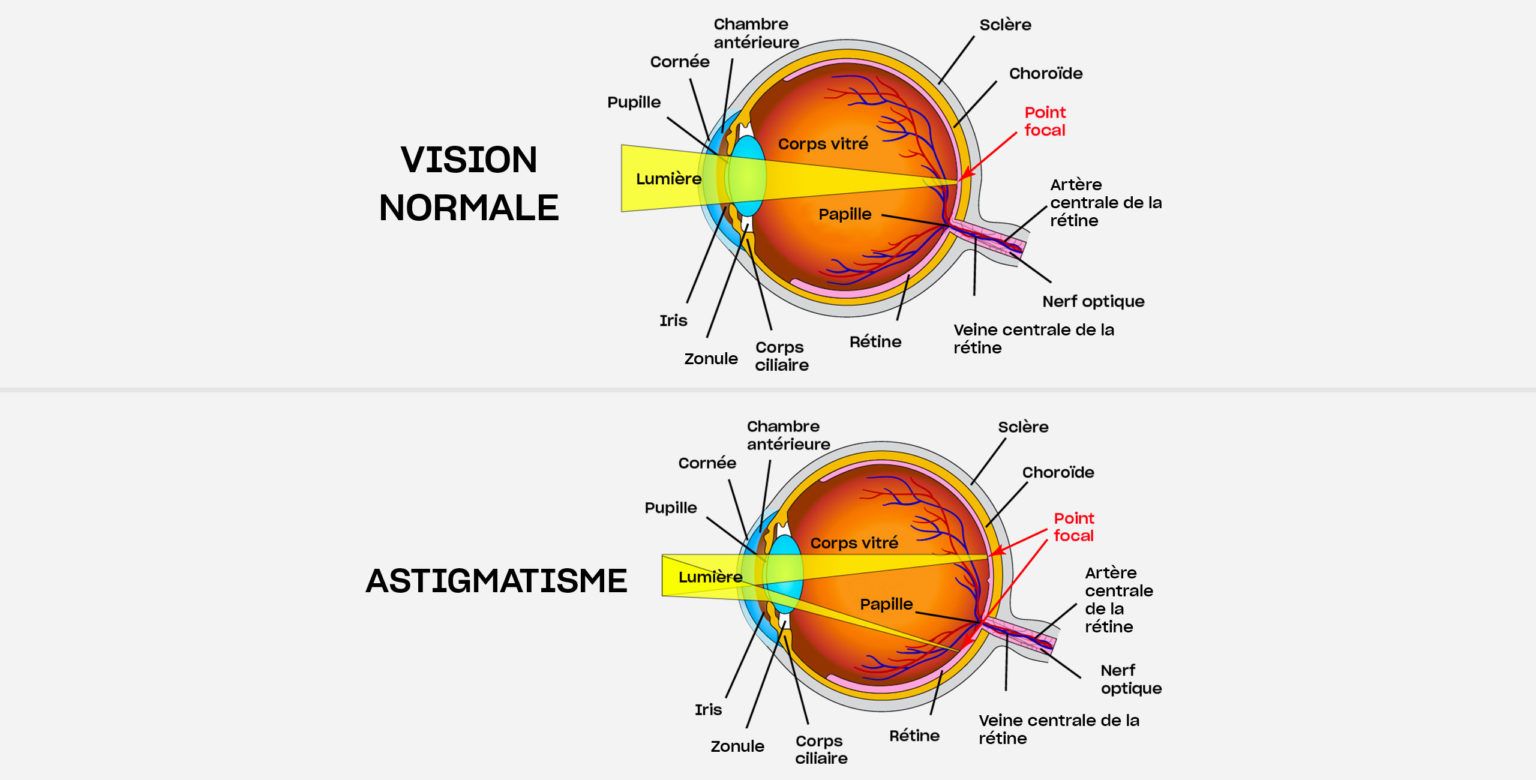 Astigmatisme diagnostic et traitement à Paris. Centre Ophtalmologique COSS