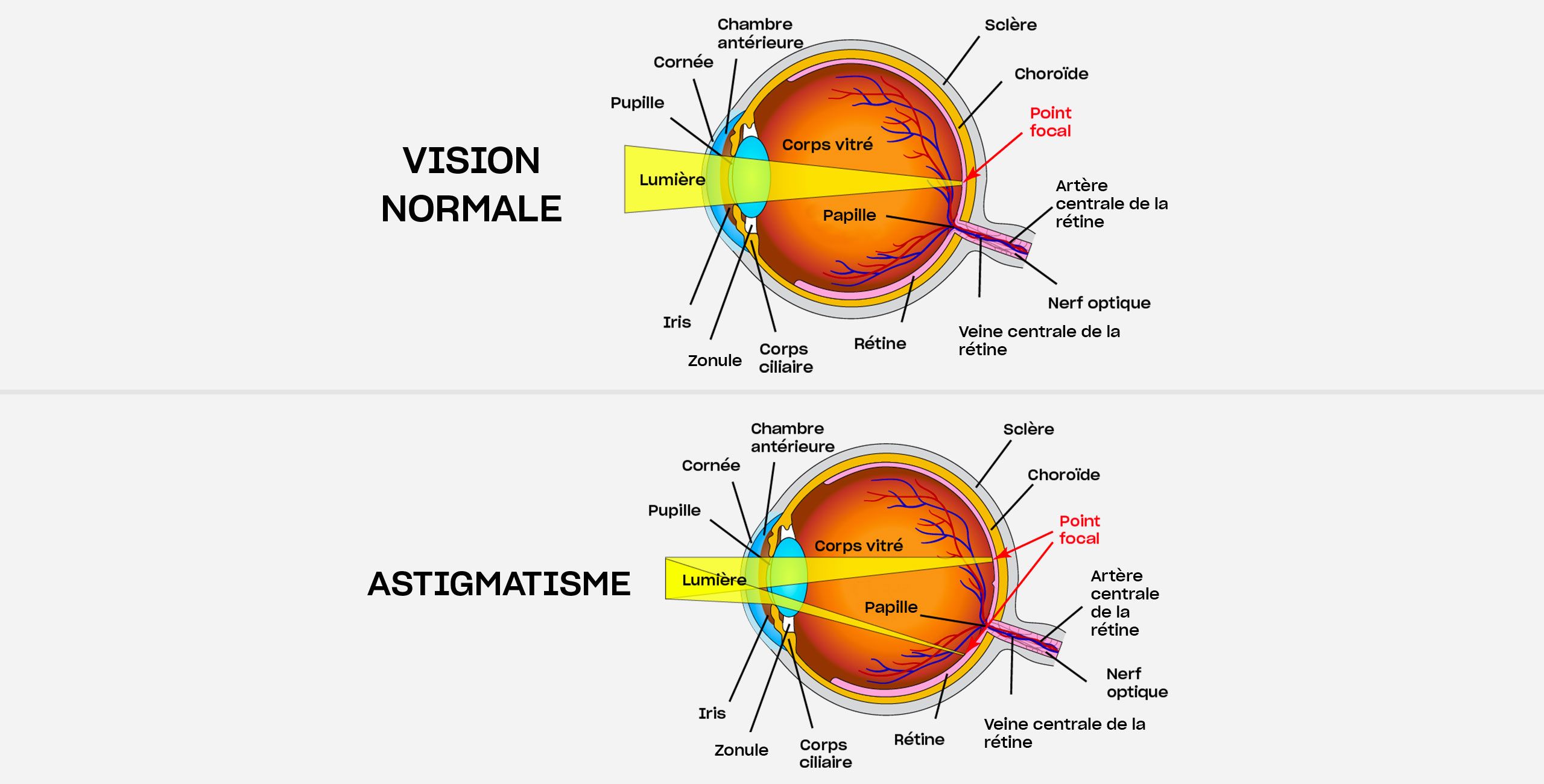 L’astigmatisme - Centre ophtalmologique COSS Paris 5