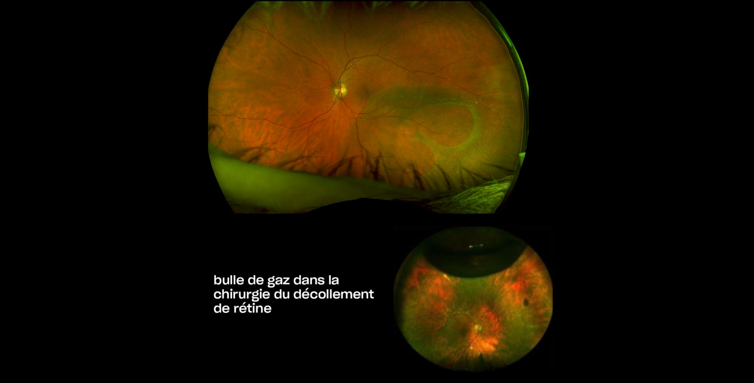 Traitement chirurgical du décollement de la rétine à Paris | COSS