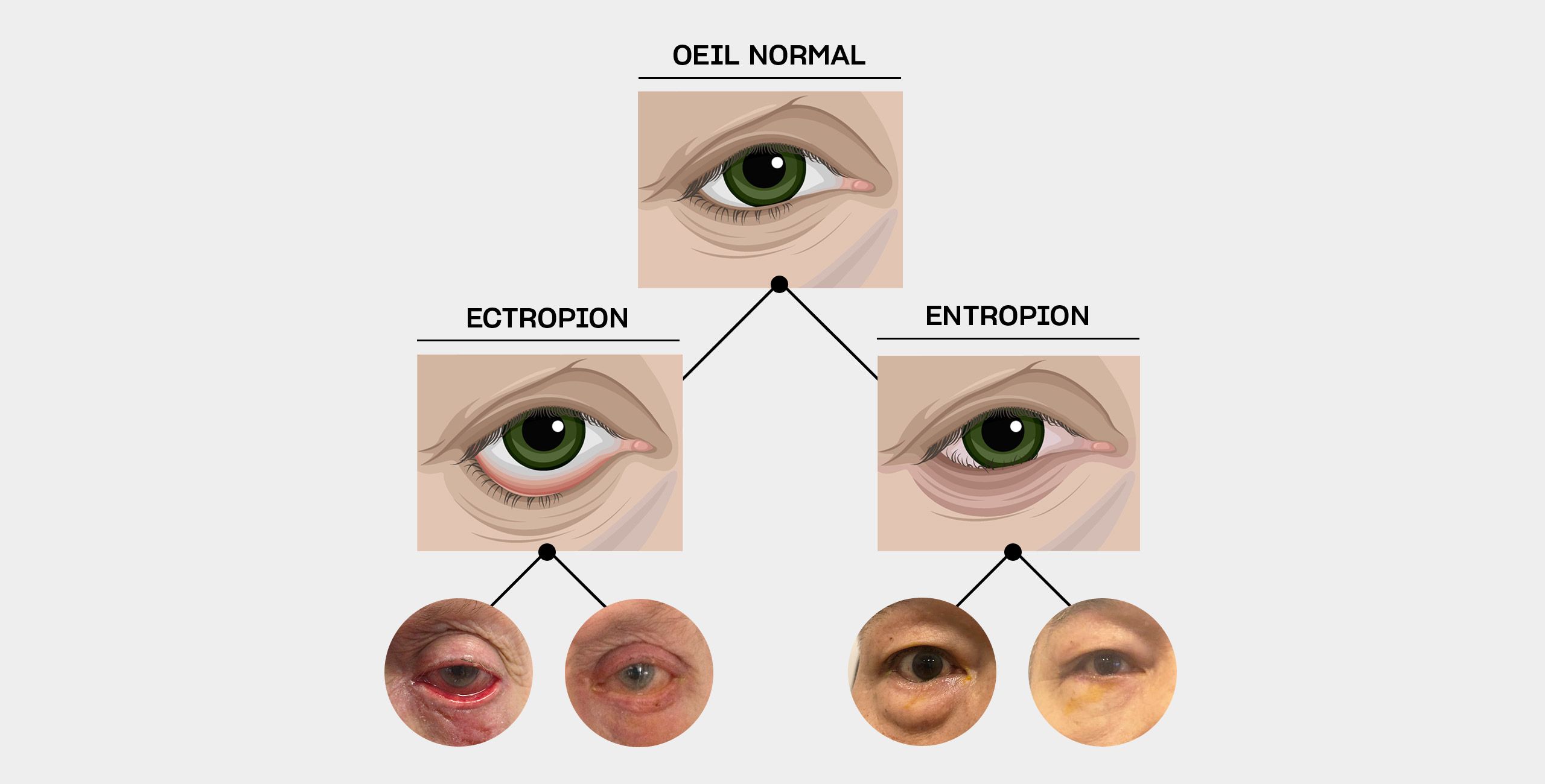 La chirurgie de l’entropion et de l’ectropion à Paris 5 au Centre ophtalmologique COSS