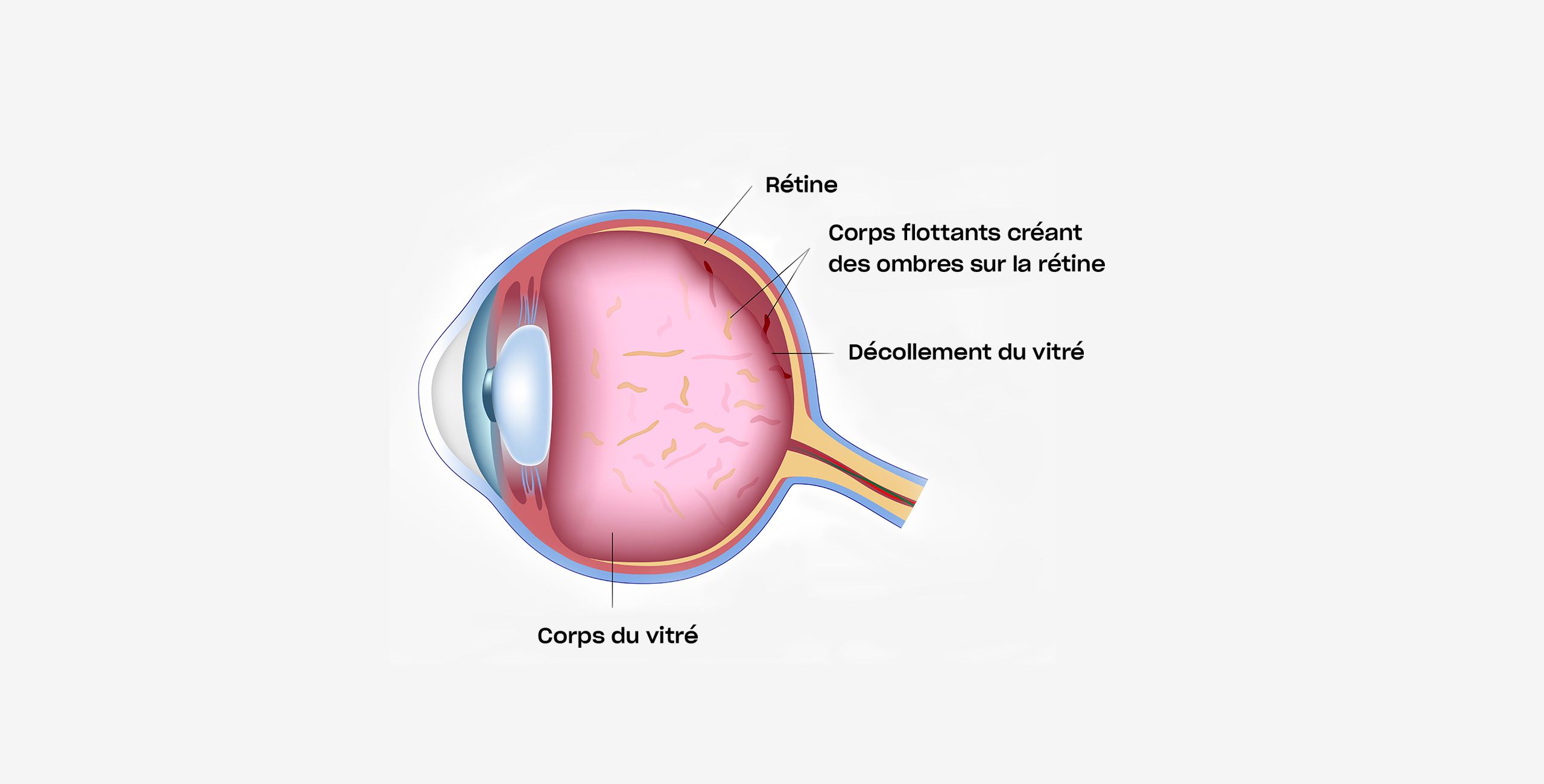 Le décollement postérieur du vitré traitement à Paris 5 au Centre ophtalmologique COSS