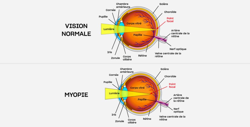 Myopie diagnostic et traitement à Paris au Centre. Ophtalmologique COSS
