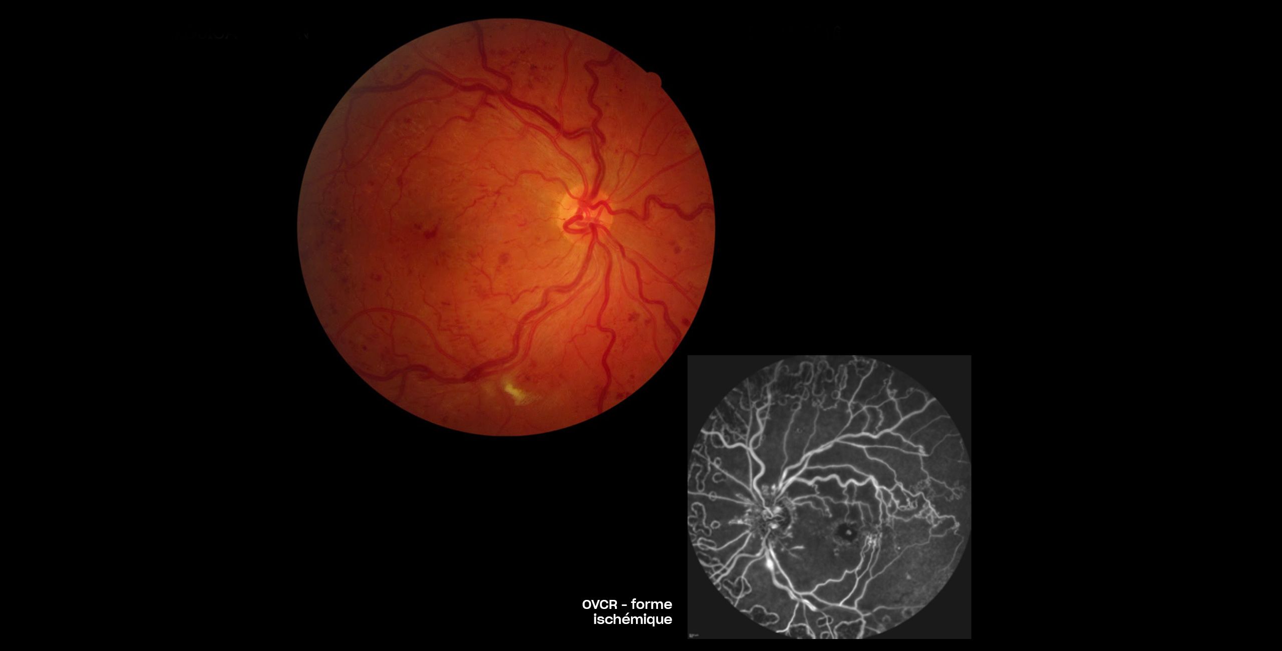 L’occlusion veineuse rétinienne - Centre ophtalmologique COSS Paris 5